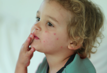 What Bed Bug Symptoms Look Like on Different Skin Types