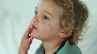 What Bed Bug Symptoms Look Like on Different Skin Types